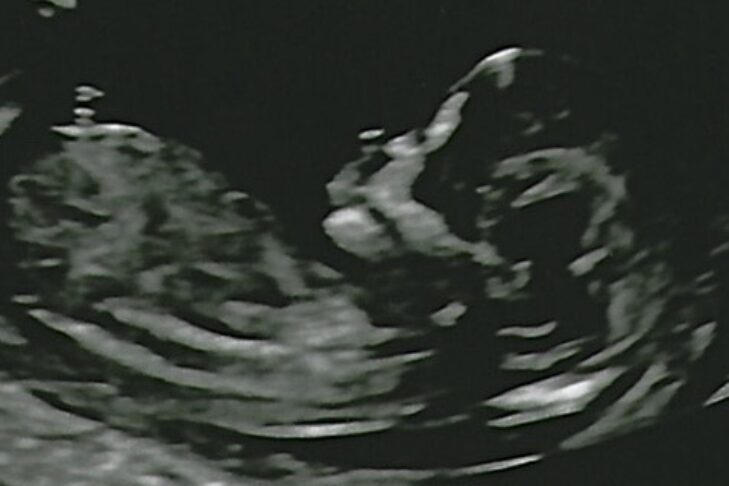 Shaney’s ultrasound image (Courtesy Shaney Wacks)